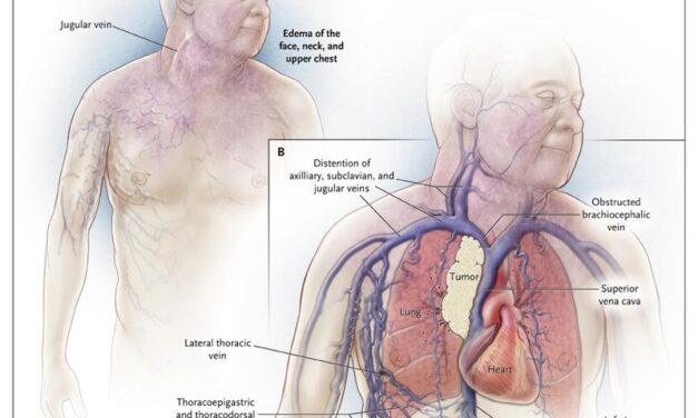 What is Lung Cancer ?  Symptoms, signs,  causes and more !