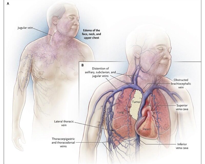 What is Lung Cancer ?  Symptoms, signs,  causes and more !